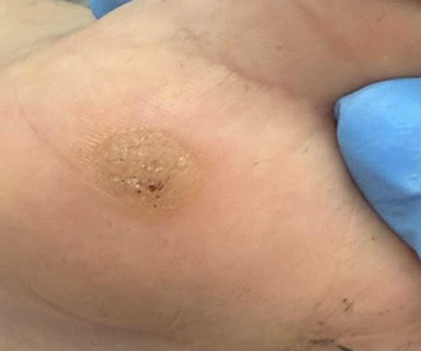 Usuwanie brodawek Gdańsk - przedstawienie metod terapii - brodawka podeszwowa wirusa HPV - przed terapią